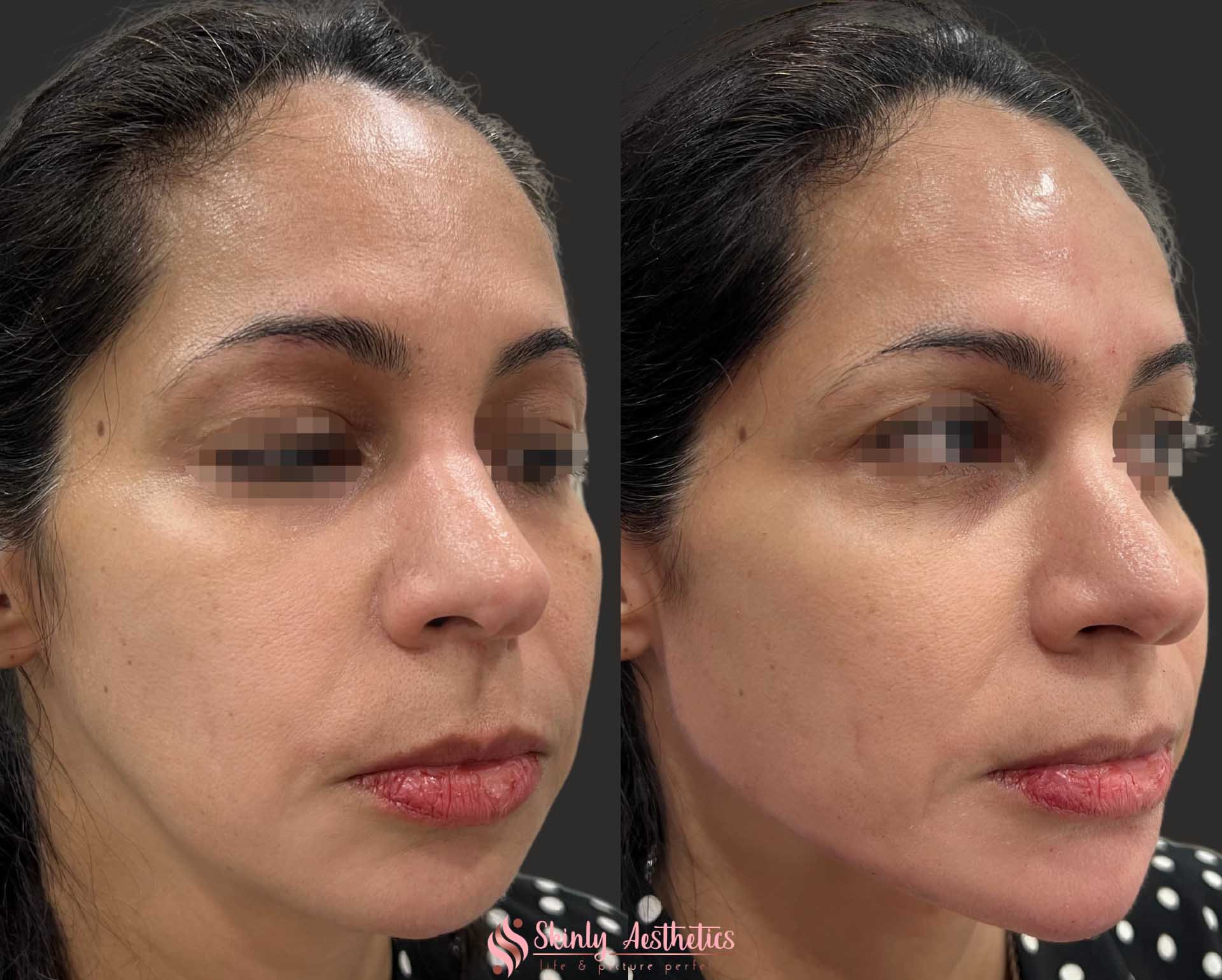 before and after results of jawline and chin reshaping with Radiesse and Juvederm fillers