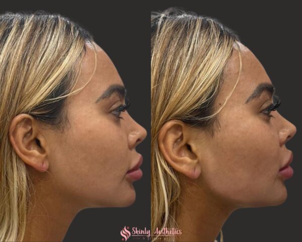 before and after results following jawline contouring and sculpting with Juvederm dermal fillers