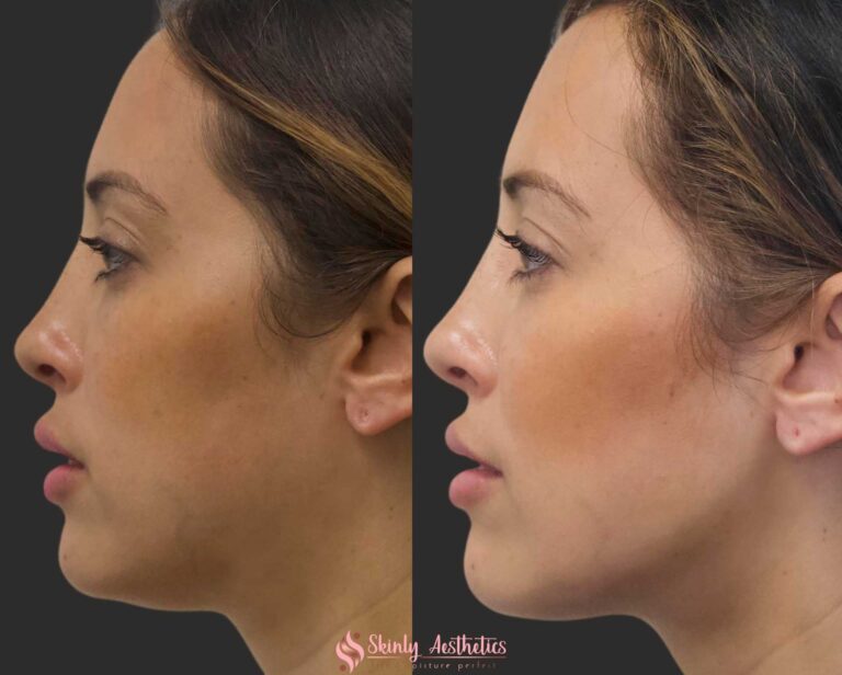 jawline contouring with botox and juvederm dermal fillers