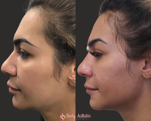 jawline Juvederm filler injections before and after