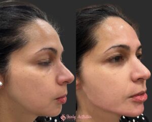 jawline sculpting before and after results following injections with 3 syringes of Radiesse filler