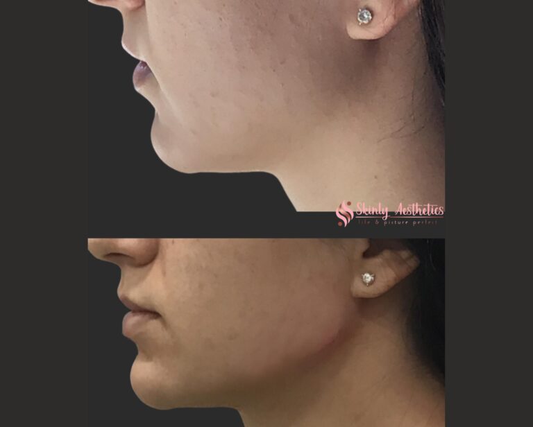 results after jawline sculpting with dermal fillers