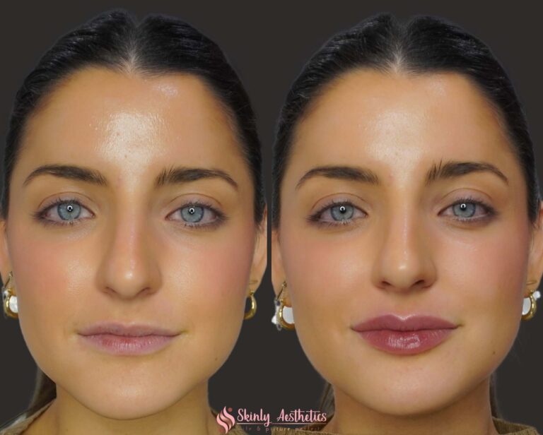 before and after results following Juvederm ultra lip filler injections