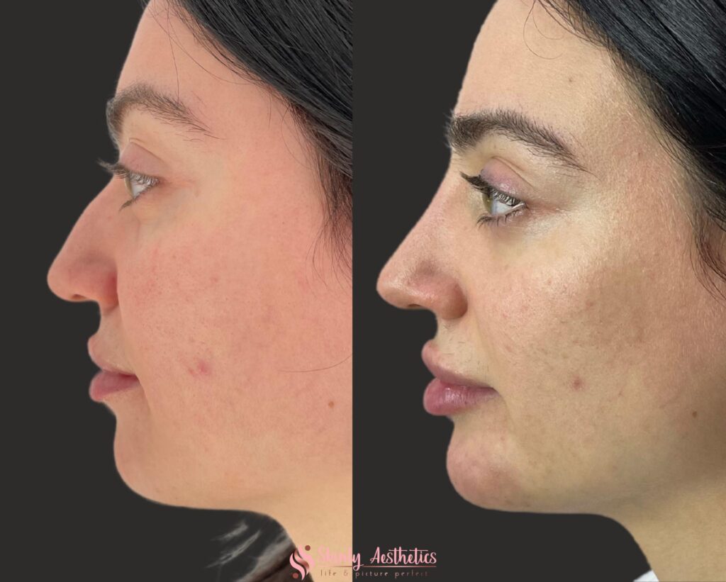 juvederm voluma chin augmentation before and after results