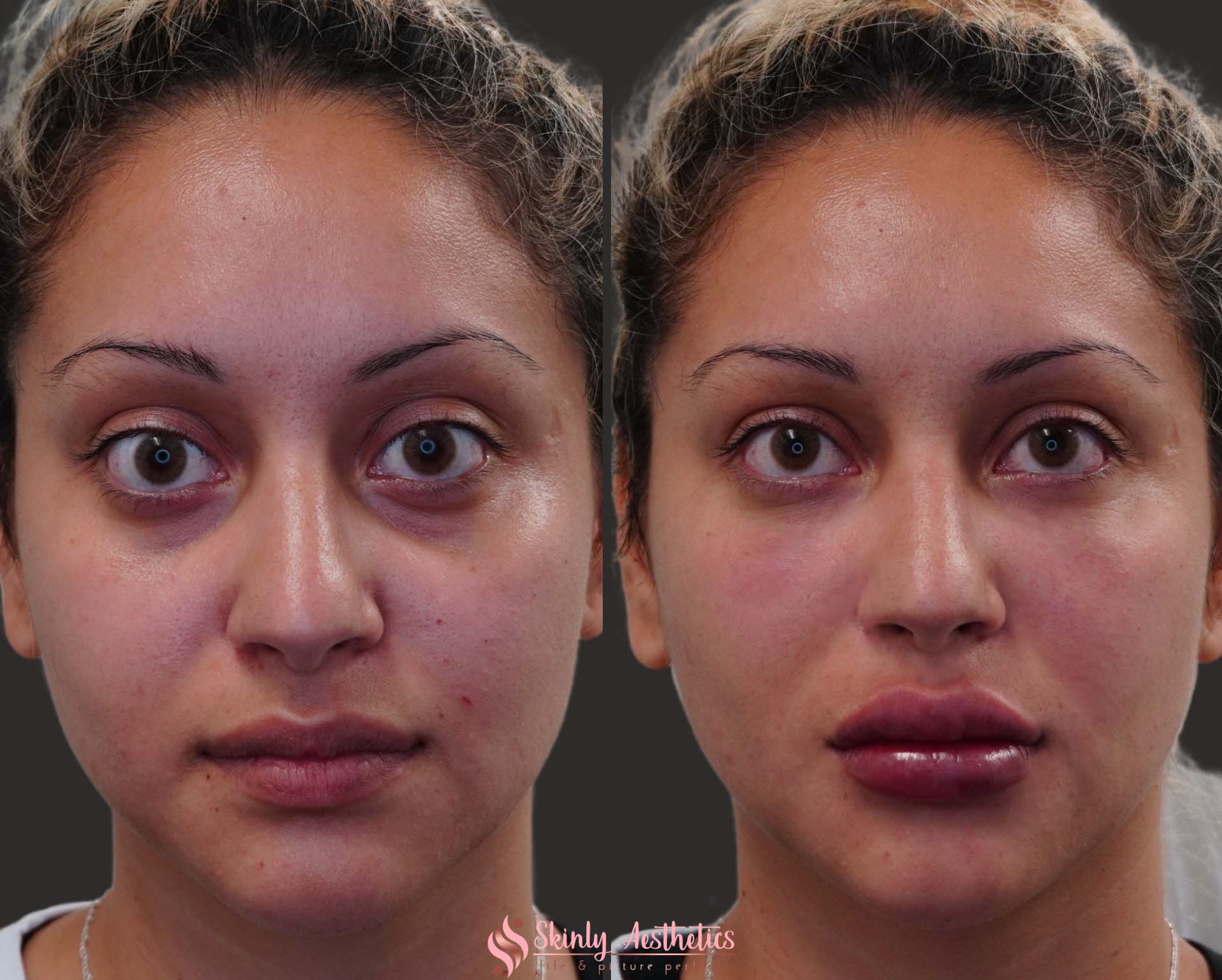 juvederm voluma lip filler injection before and after results