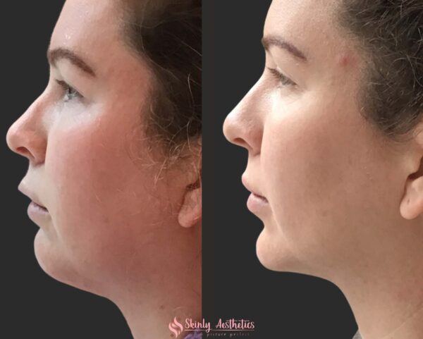 before and after results of Kybella treatment for double chin fat reduction
