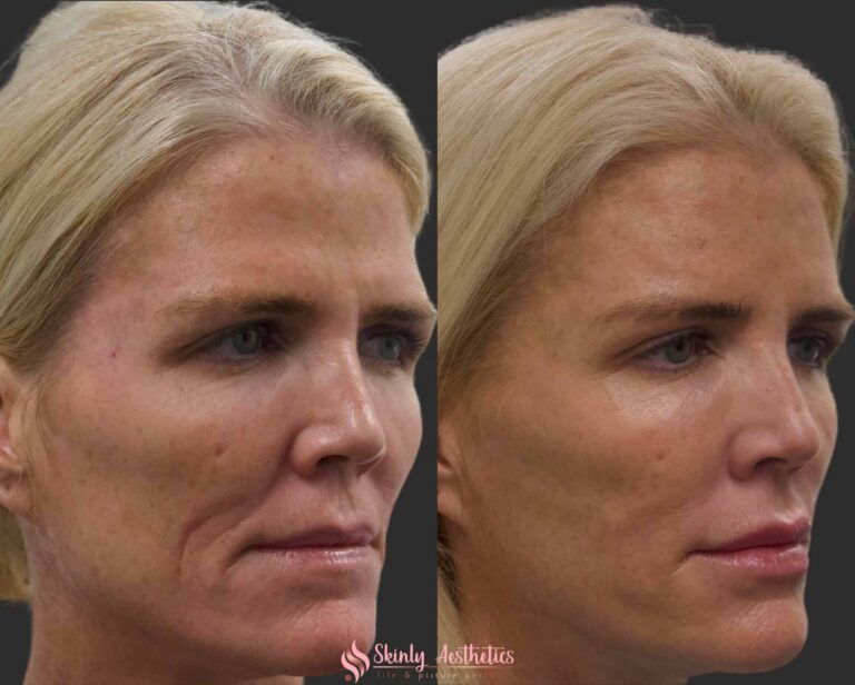 before and after results following laugh lines correction with Juvederm Ultra filler