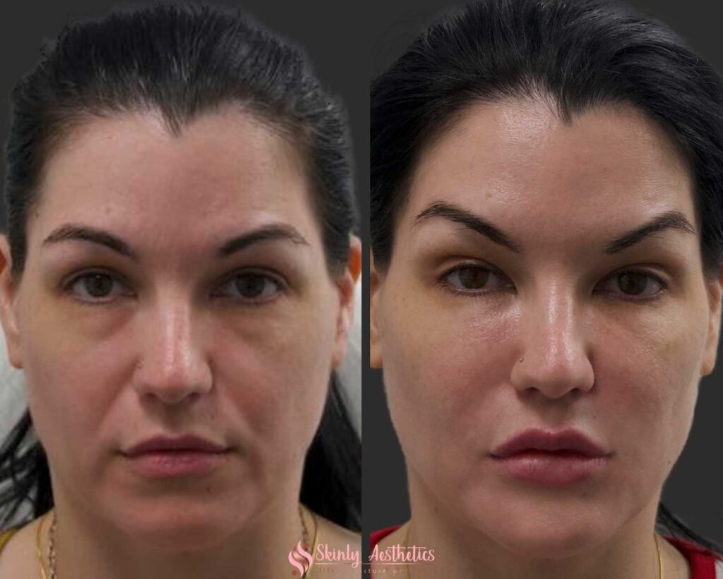 before and after Juvederm filler for laugh lines