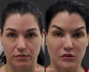 before and after results following Juvederm filler injections for laugh lines