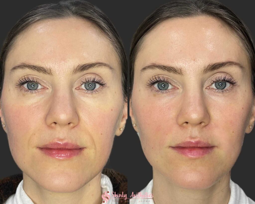 before and after results demonstrating smoothing of the laugh lines with Juvederm Ultra dermal filler