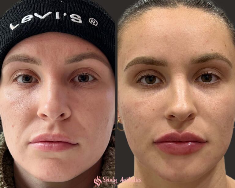 natural plump results after lip augmentation with Juvederm ultra