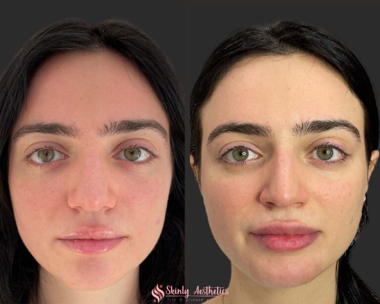 before and after results of lip augmentation with Juvederm filler
