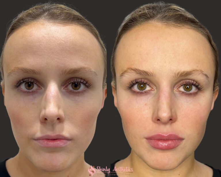 lip augmentation before and after results following Juvederm Ultra filler injections