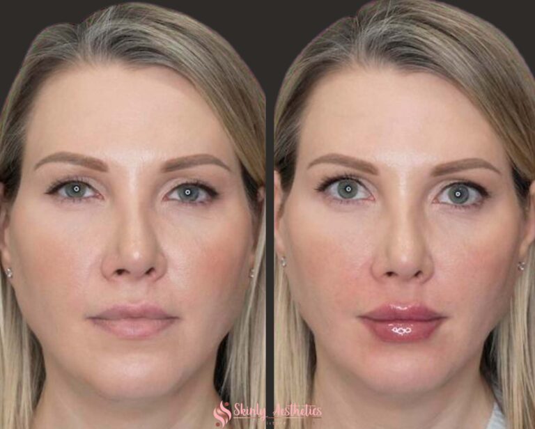 Juvederm Ultra lip enhancement before and after the treatment