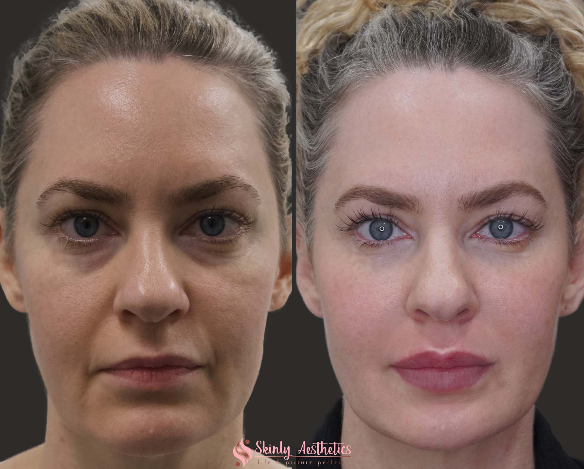 Juvederm Ultra lip filler injection before and after results