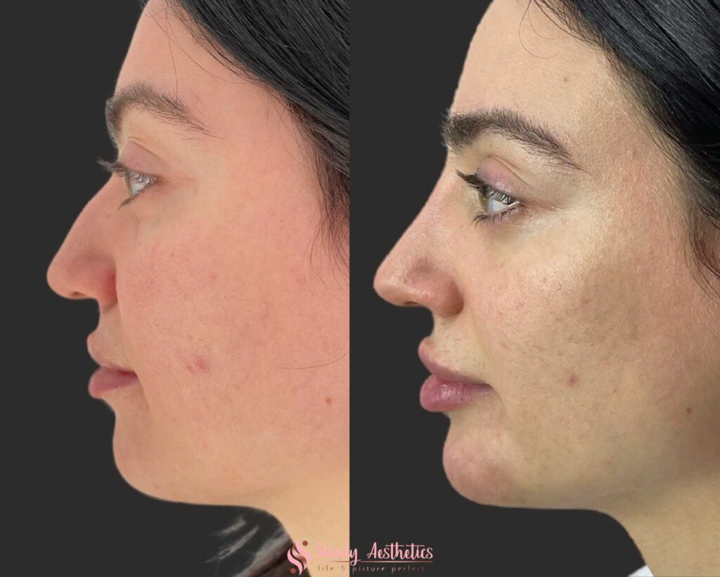 before and after results following liquid rhinoplasty with Restylane filler