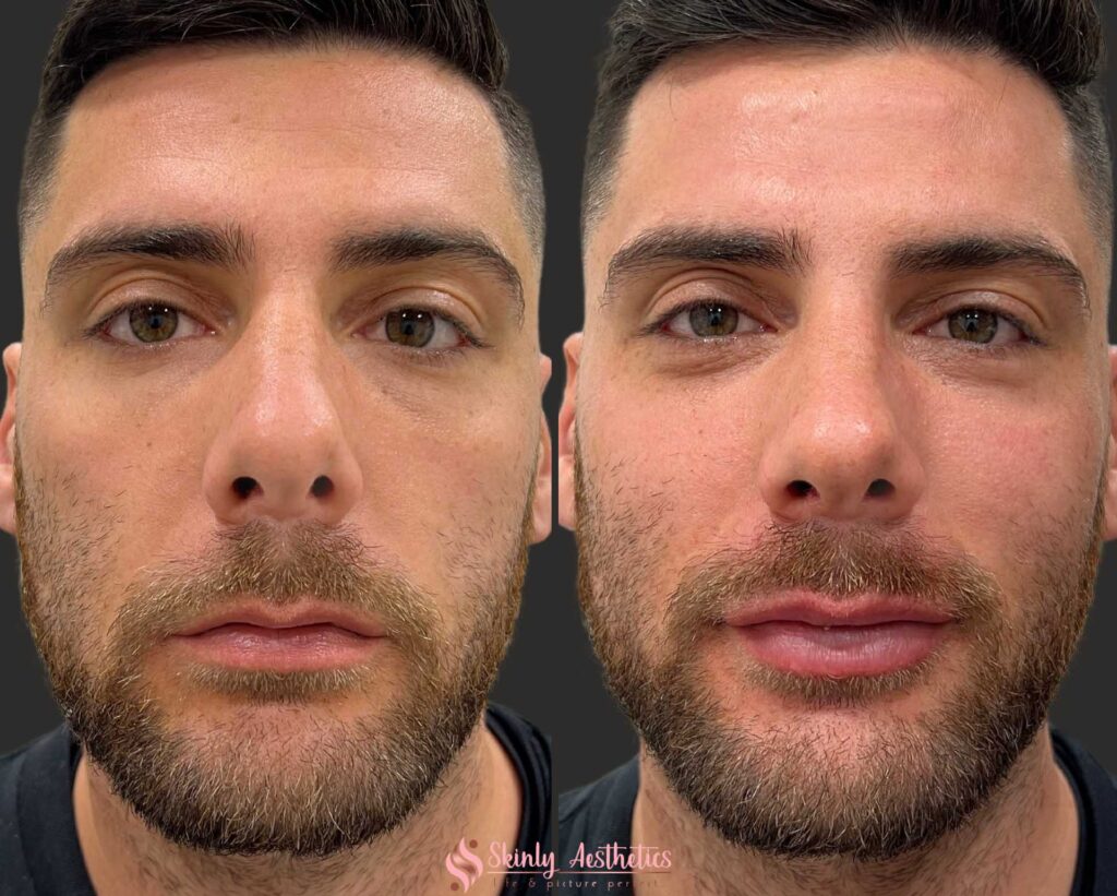 before and after lip filler results in male patient with Juvederm Ultra