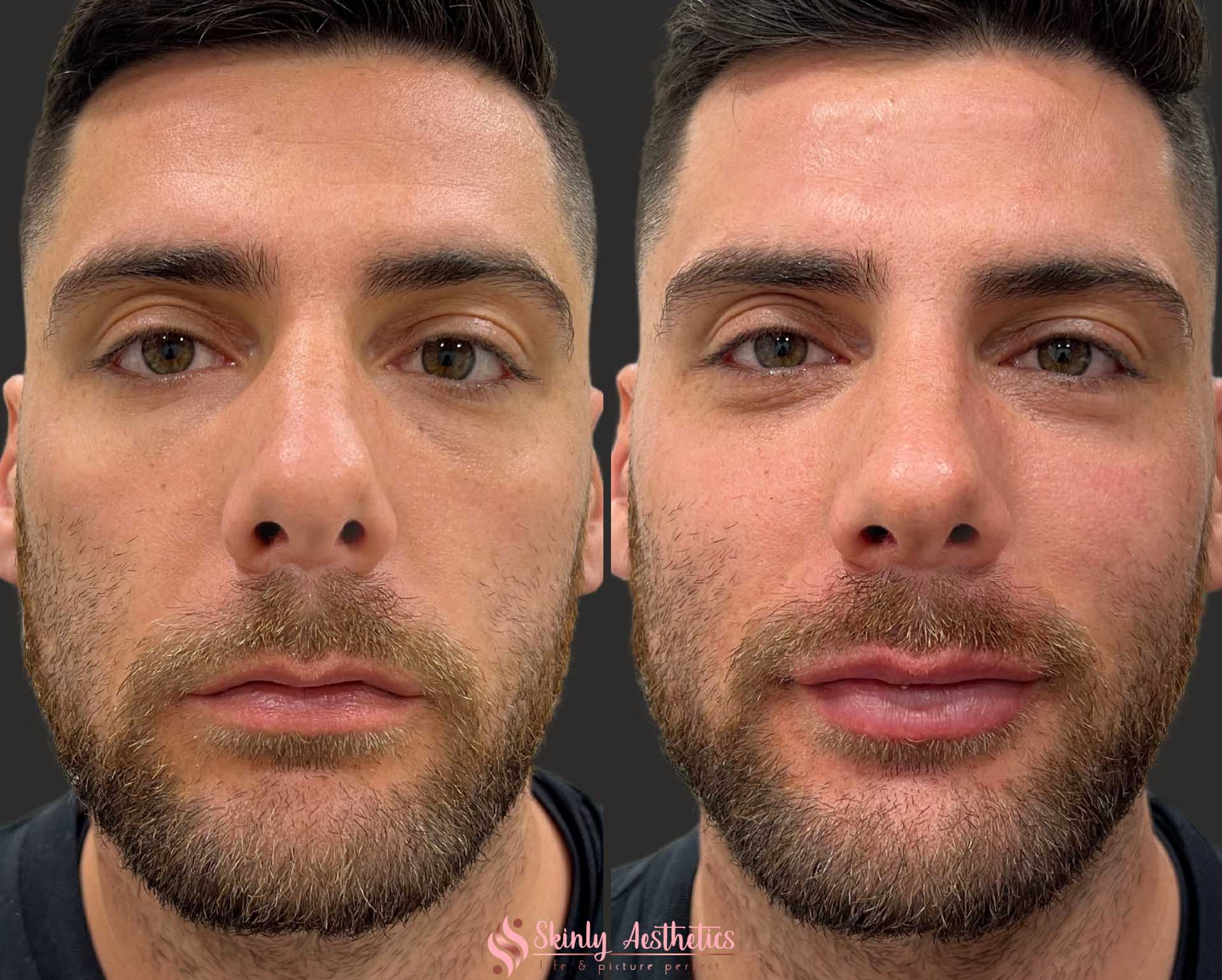 Lip Filler Before After Results Skinly Aesthetics