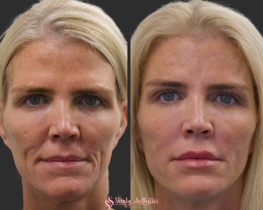 before and after nasolabial and marionette lines treatment with Juvederm filler