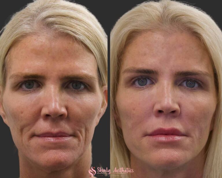 before and after results following nasolabial and marionette lines treatment with Juvederm filler