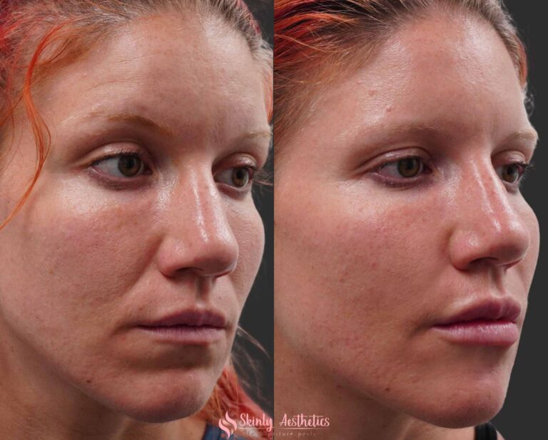 results after smile line injections with hyaluronic acid filler