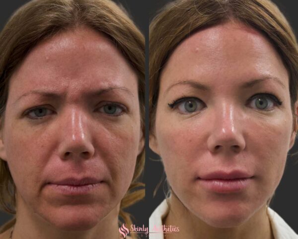 before and after smile line injection with Juvederm filler