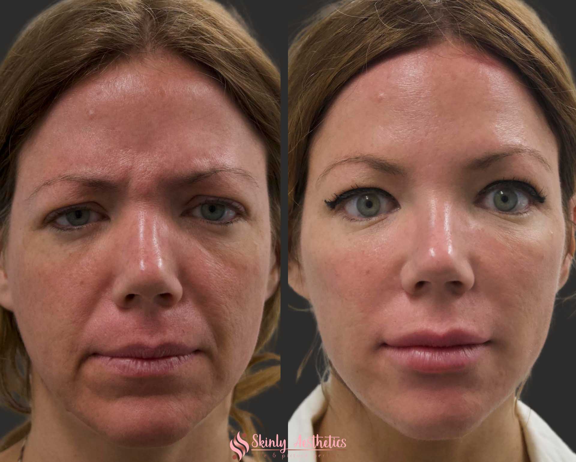 Smile Line Fillers Before After Results At Skinly   Nasolabial Fold Correction With Juvederm Filler 