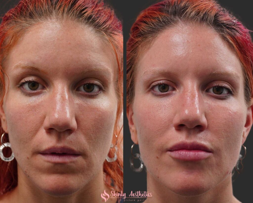 before and after Restylane filler injection to reduce the appearance of deep nasolabial smile folds