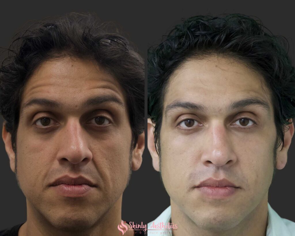 results after nasolabial laugh line injections with Restylane