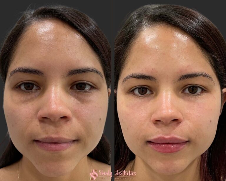 natural lip results following injection with Juvederm hyaluronic acid filler