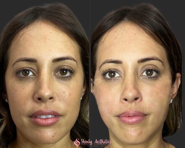 before and after results of non-surgical PDO thread facelift