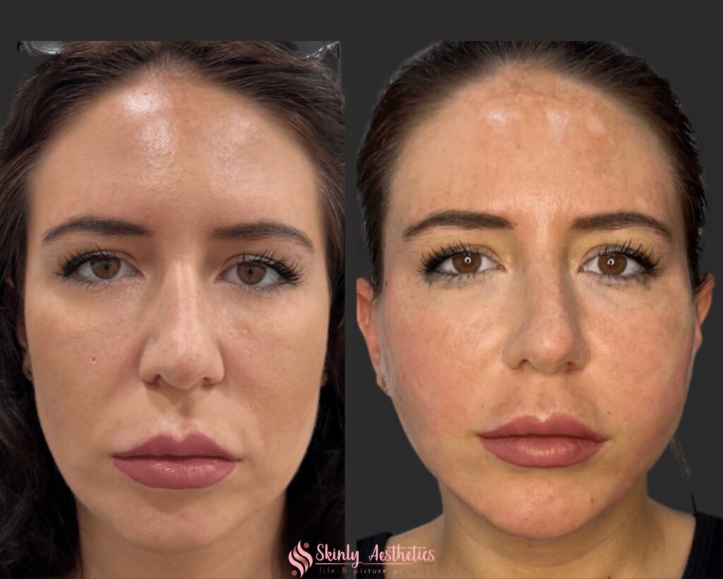 before and after results of non-surgical PDO thread face lift