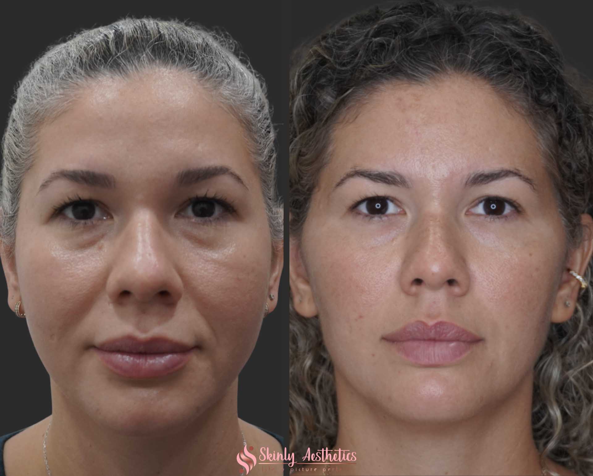 before and after results of the face following non-surgical PDO thread lift