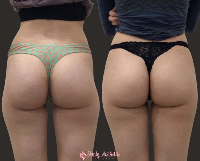 buttocks injections before and after photos