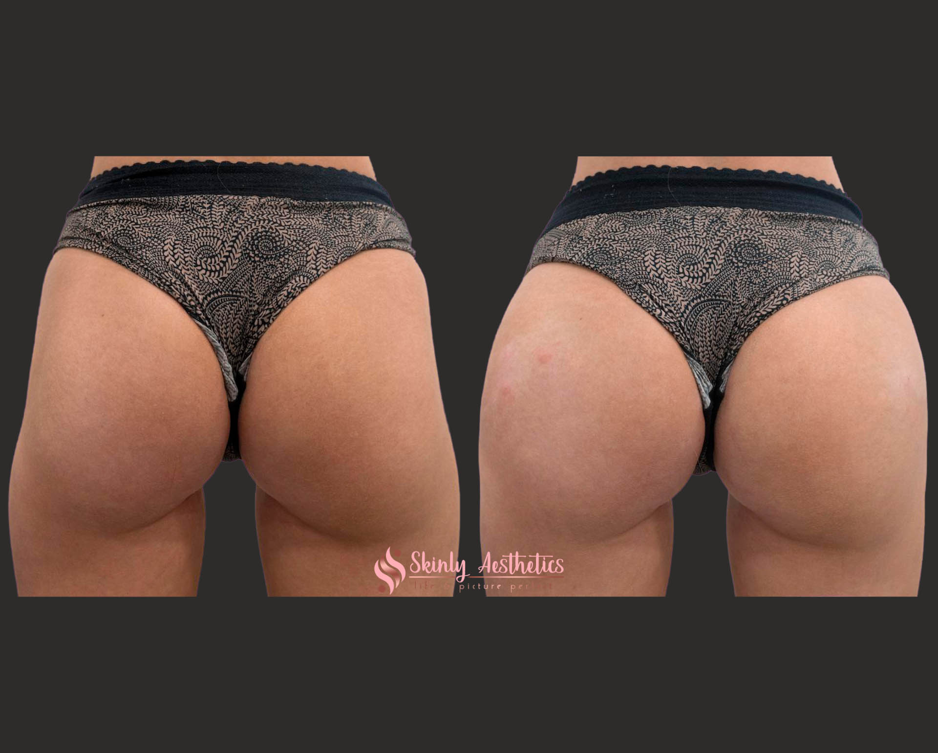 before and after results of non-surgical butt lift with Sculptra filler