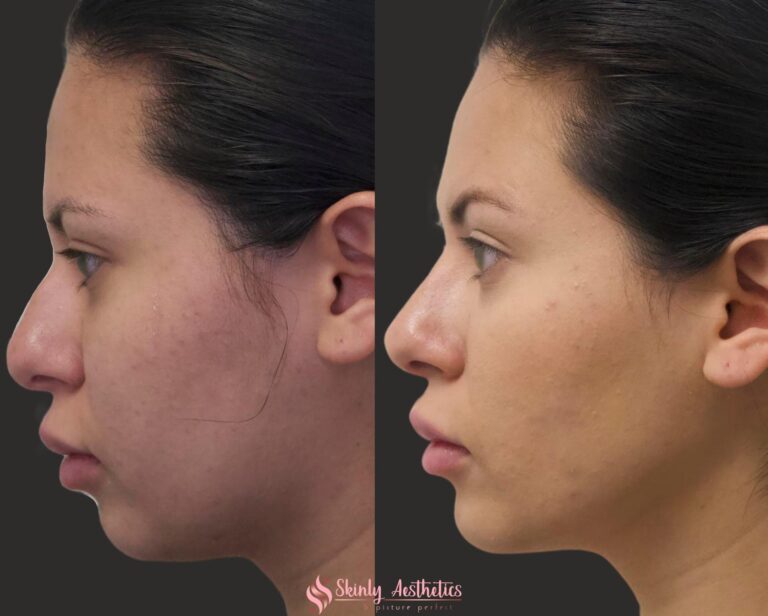 before and after non-surgical chin and jawline augmentation with Juvederm Voluma