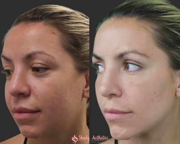 results after non-surgical chin contouring with Restylane