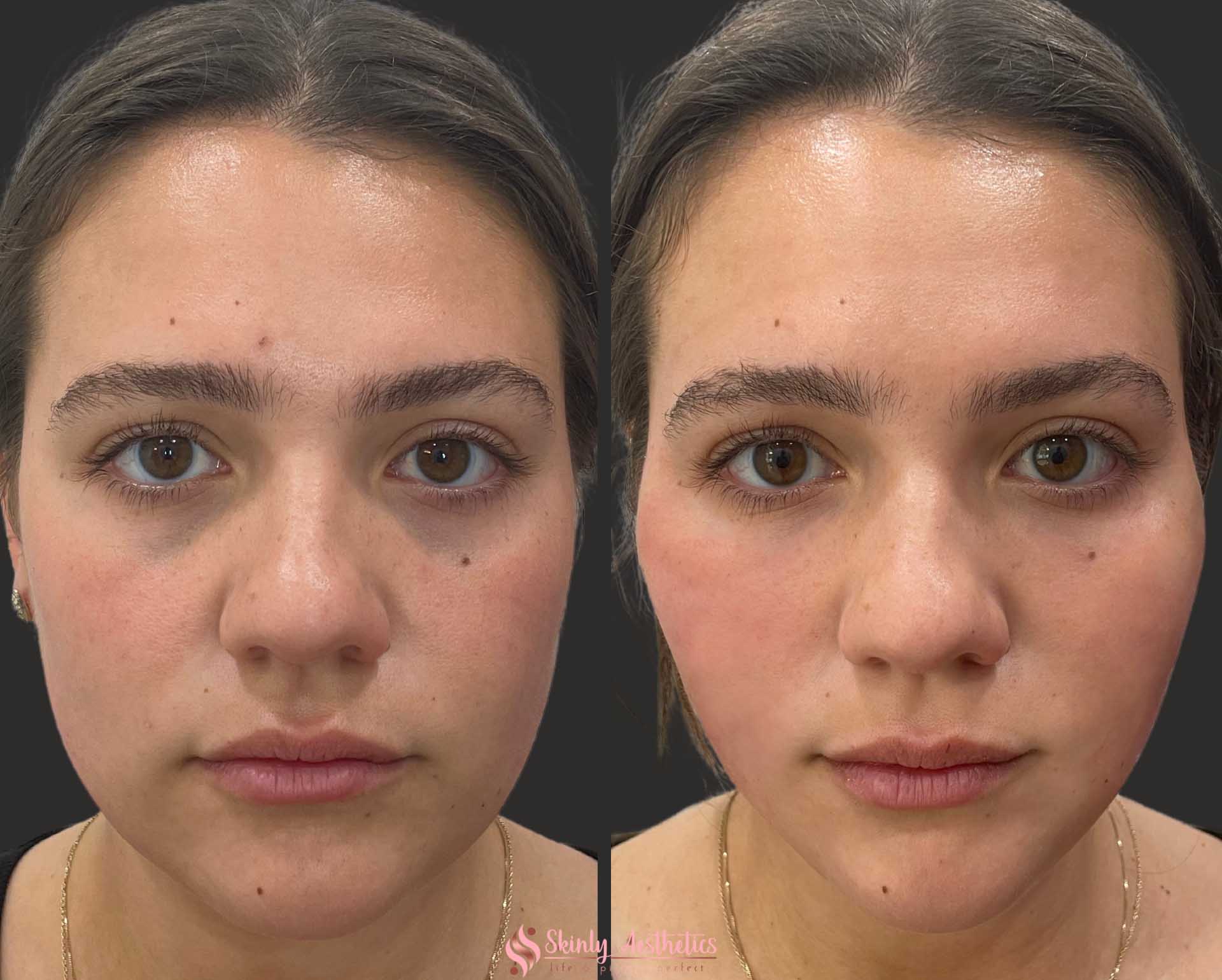 before and after results of non-surgical PDO thread lift for facial lifting and tightening