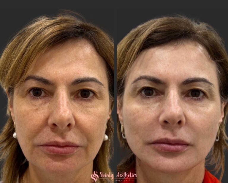 before and after results following smooth and barbed PDO face threadlifting for a non-surgical facelift