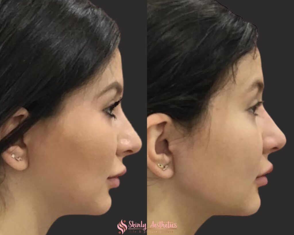 before and after results following non-surgical jawline augmentation with Radiesse and Juvederm fillers