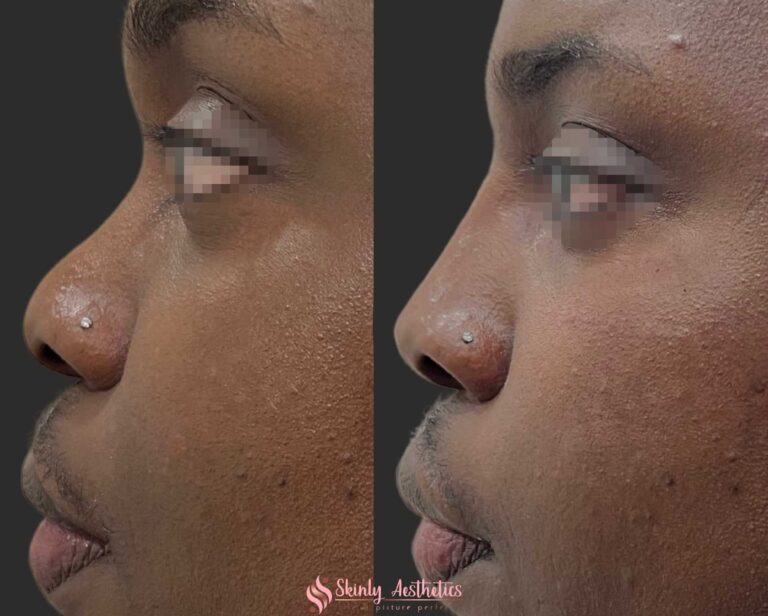 non-surgical rhinoplasty before and after results with Juvederm Voluma to raise the bridge and tip of the nose