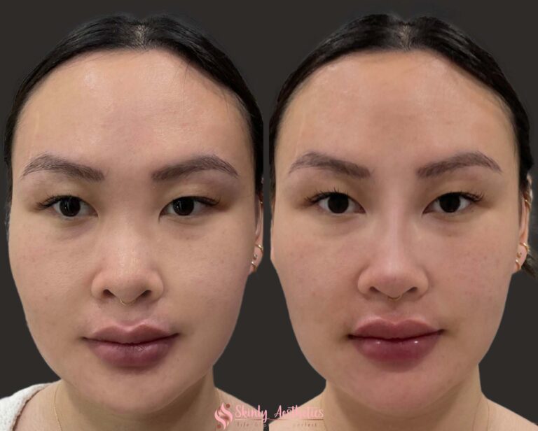 results after getting 1 syringe of Juvederm Voluma to slim and sculpt the nose without a surgery