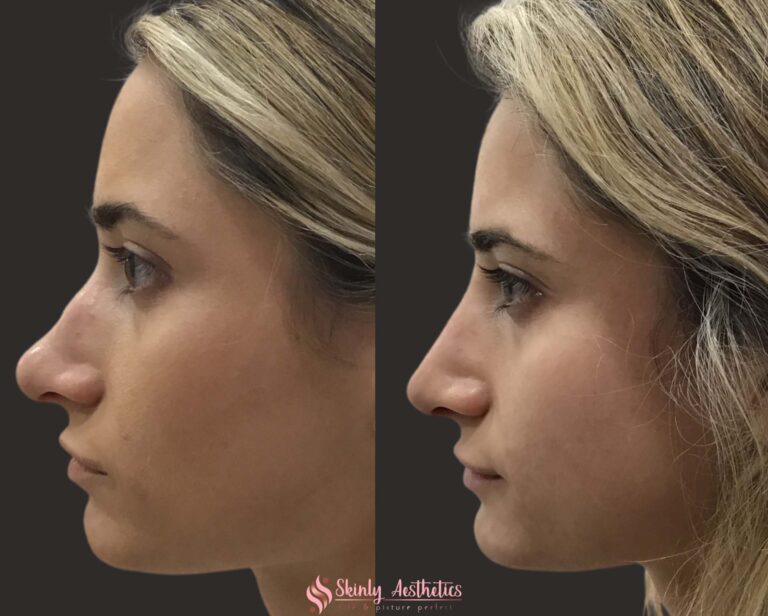 before and after results following non-surgical rhinoplasty with Juvederm Voluma filler