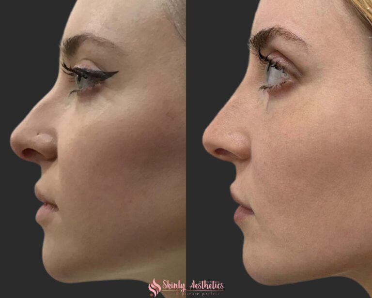 before and after results following nose filler for contouring and nose tip lifting