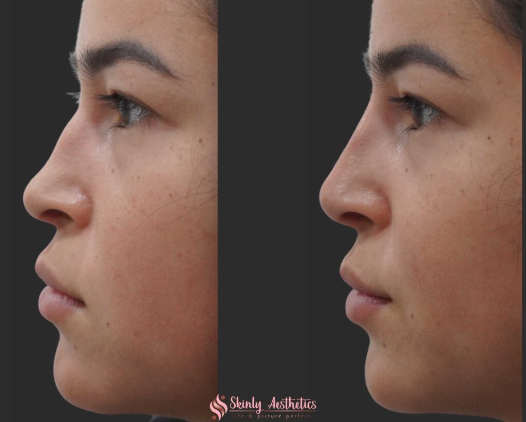 results after nose filler injections with 1ml of Juvederm Voluma to slim the nose