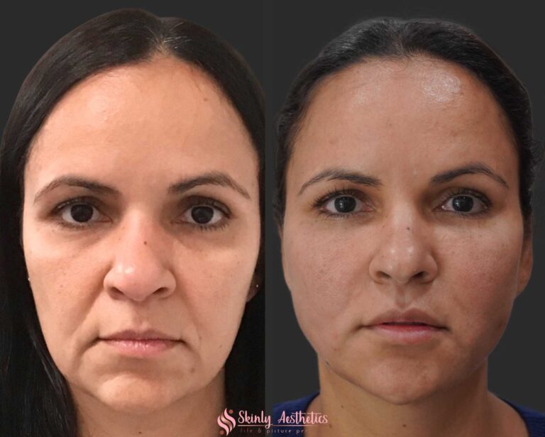 PDO Thread Lifting - Before and After Results at Skinly Aesthetics