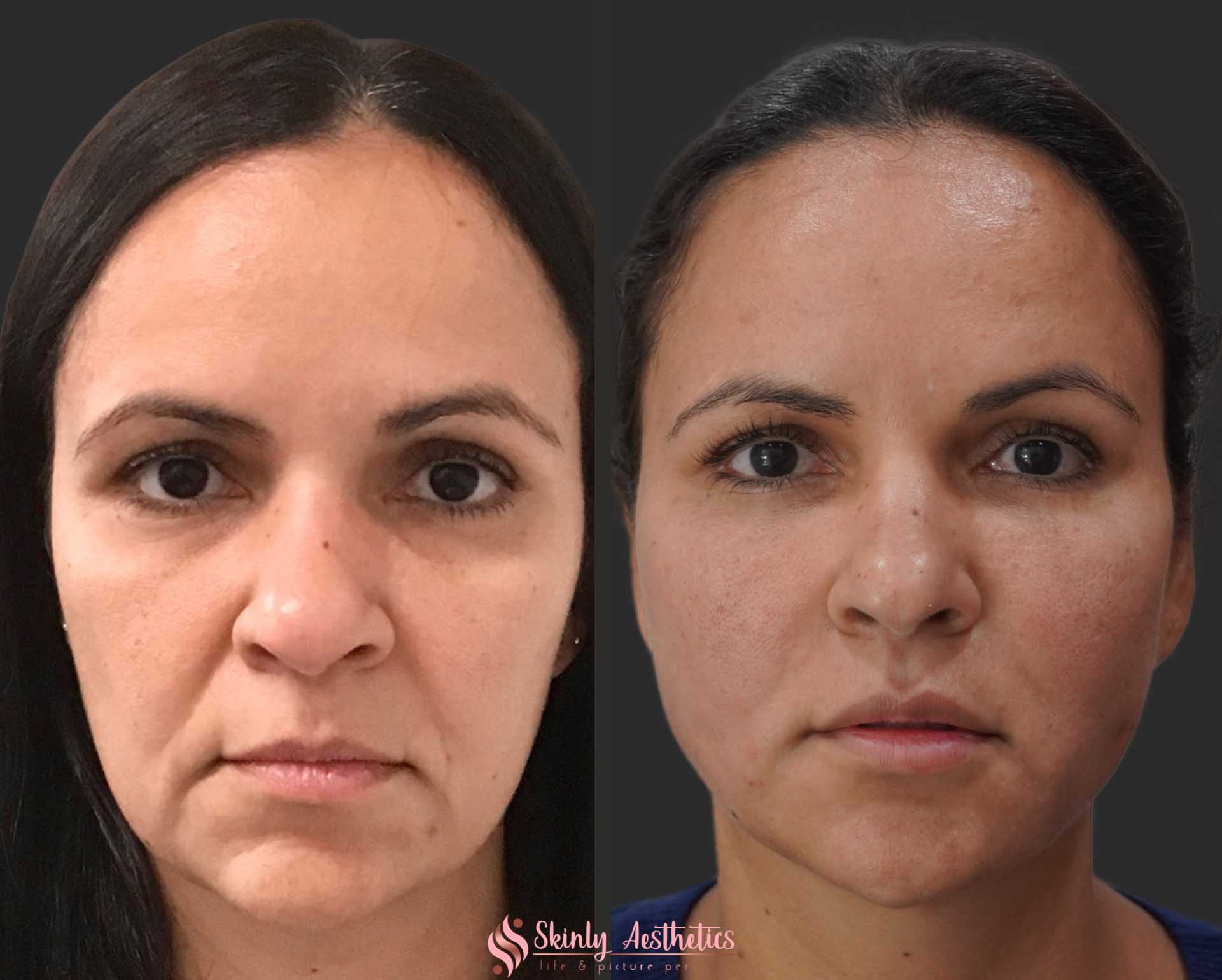 before and after results of PDO thread lift