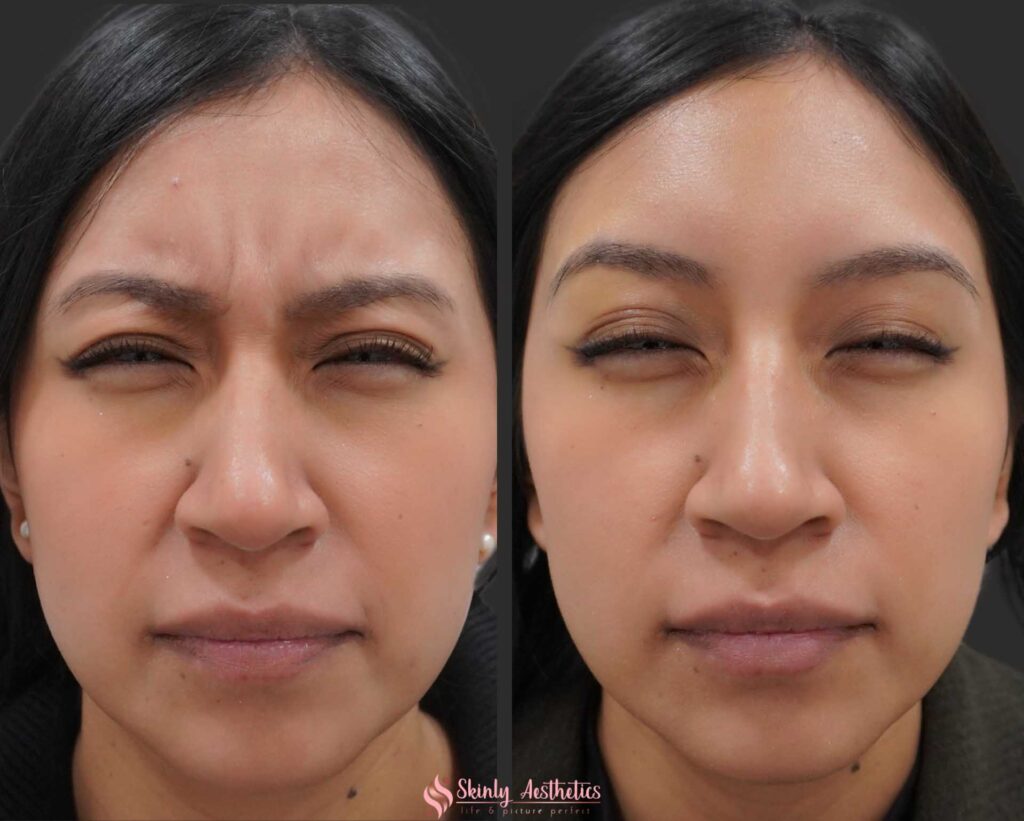 results demonstrating complete resolution of 11s lines following administration of 20 units of Botox