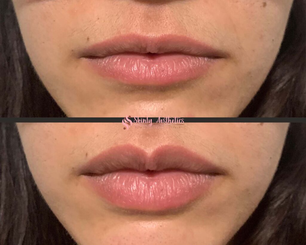 restylane lip filler results