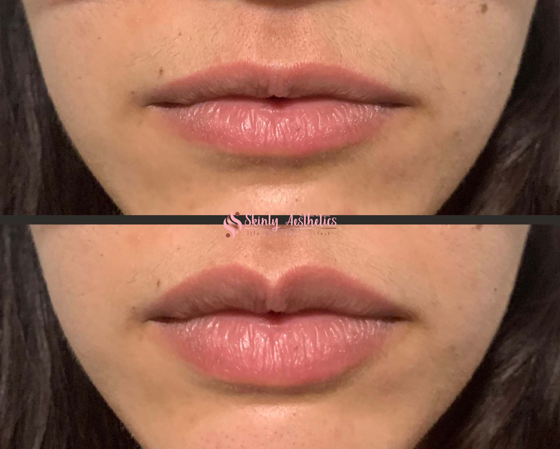 restylane lip filler injections before and after results